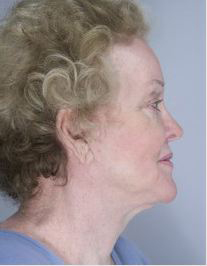 avant apres lifting cervico facial