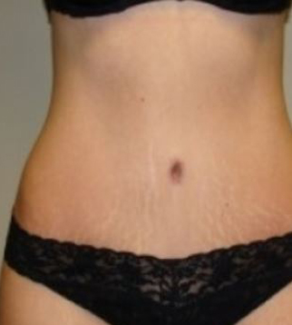 liposuccion ventre moyenne