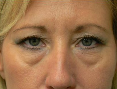 avant apres lifting cervico facial