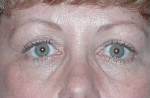 avant apres lifting cervico facial