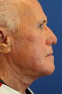 avant apres lifting cervico facial