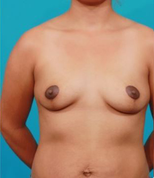 lifting seins asymetriques
