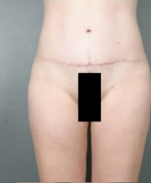 avant apres lipoaspiration ventre et culotte cheval