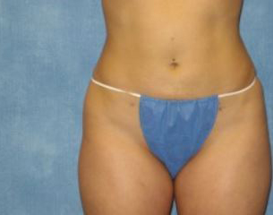 liposuccion ventre moyenne