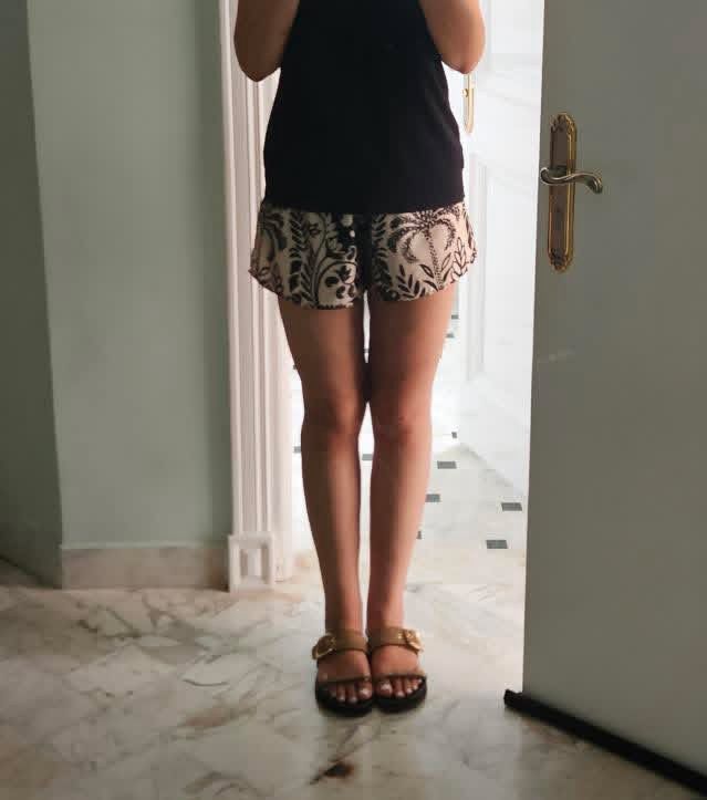 après opération lipoedème