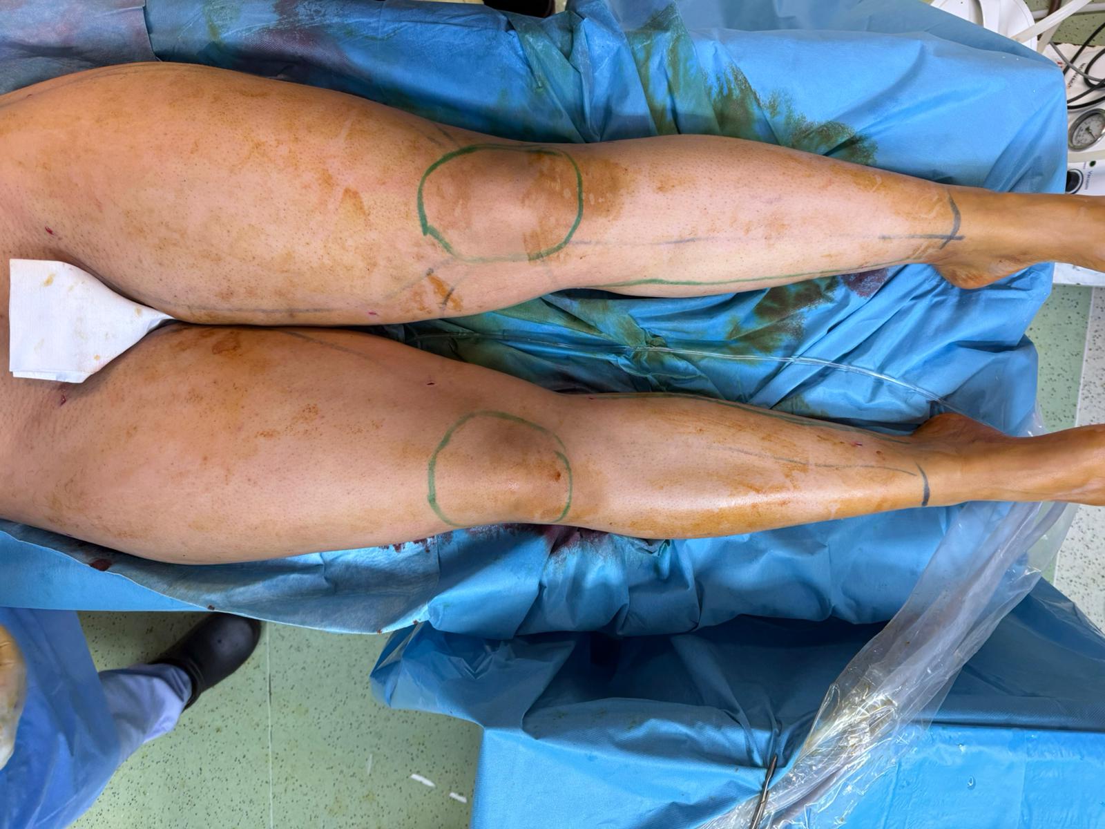 avant opération lipoedème