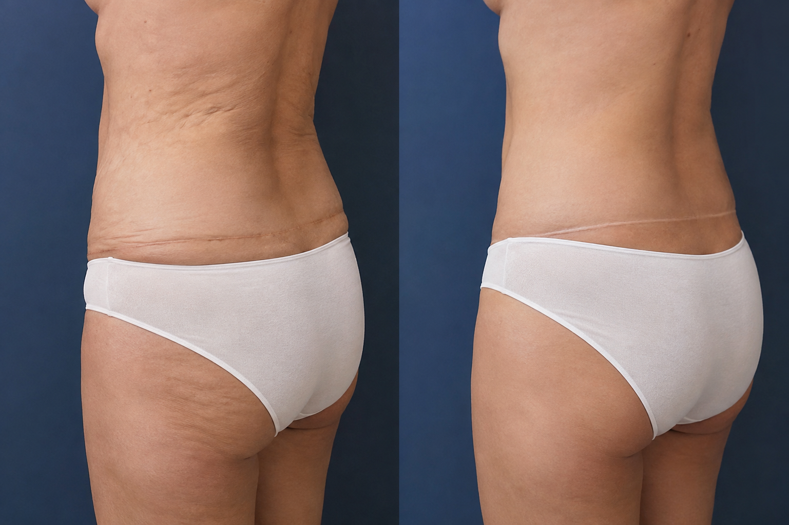 bodylift après perte de poids et remodelage de la silhouette bodylift après perte de poids et remodelage de la silhouette