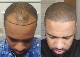 Greffe cheveux afro en Turquie : Greffe cheveux crépus à Istanbul avec Medespoir