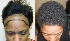 greffe cheveux afro femme résultat