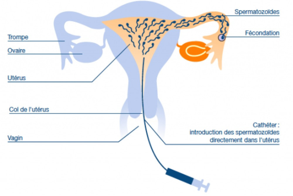insemination intra-uterine