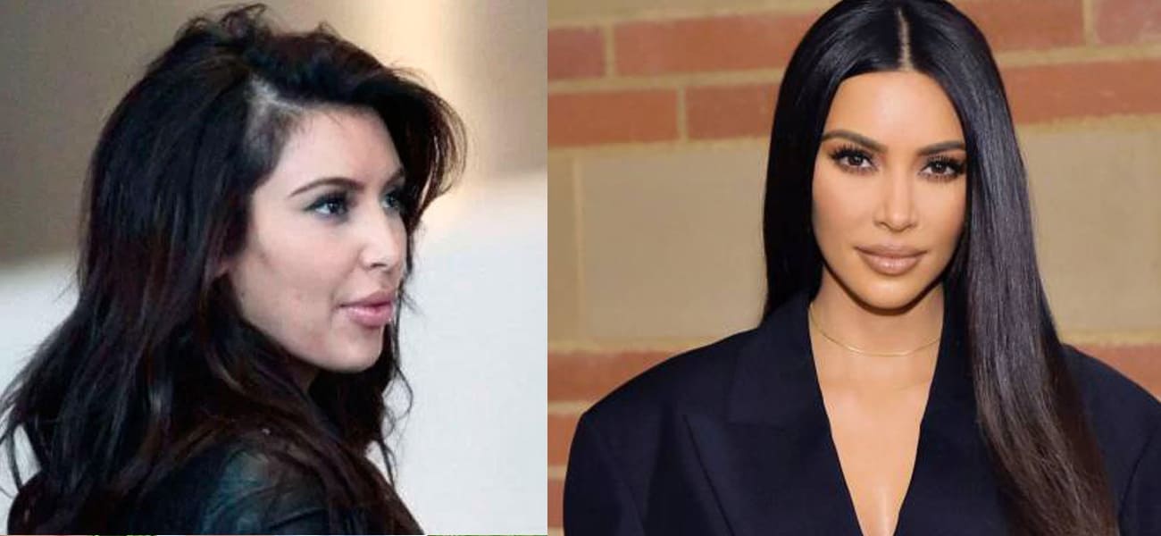 chirurgie greffe cheveux Kim Kardashian 