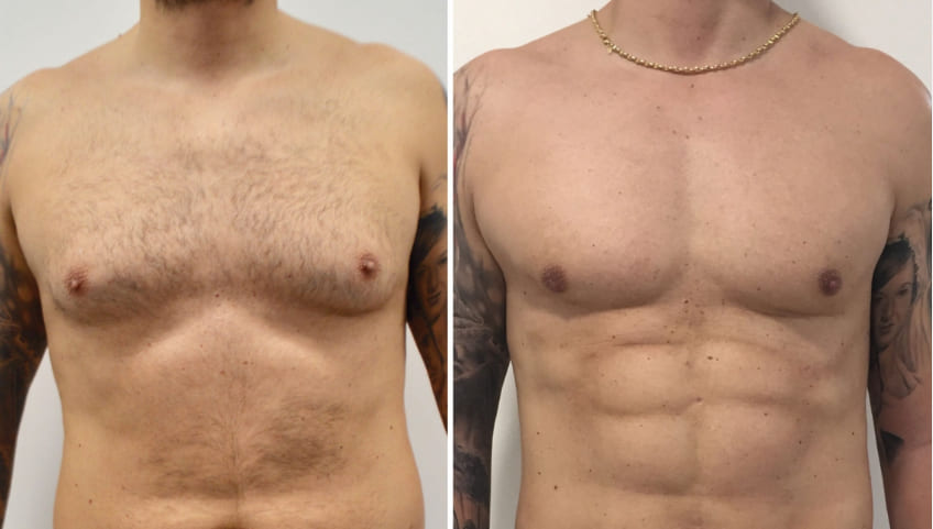 vaser lipo homme avant-après-abdominaux