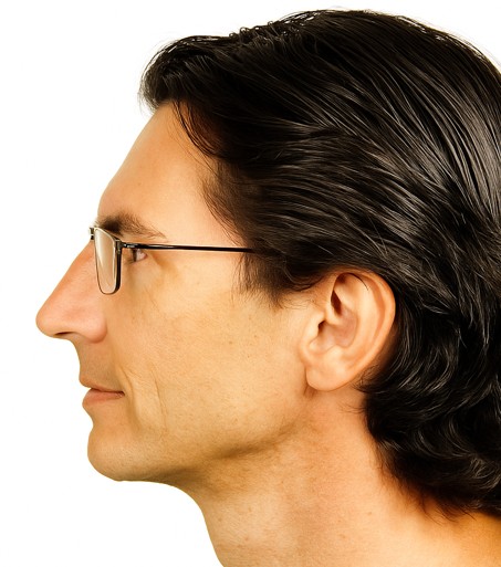 Profil gauche - après rhinoplastie