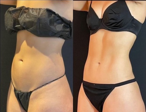 c'est quoi lipo Liposuccion / Liposculpture main image 0