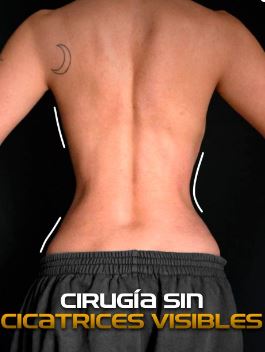 Silhouette sablier après remodelage costal RibXcar