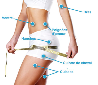 silhouette-liposuccion-cryolipolyse