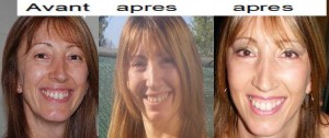 resultat blepharoplastie avant apres