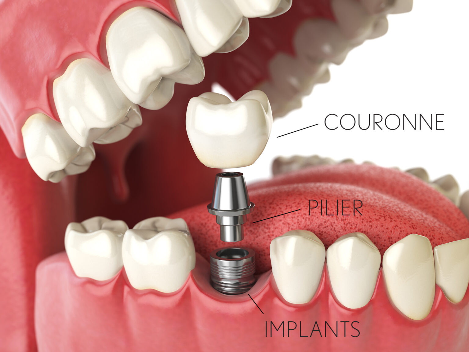 Implant dentaire complet prix Medespoir