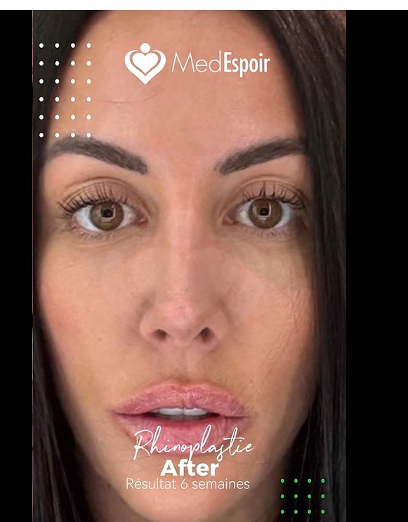 Photo après rhinoplastie Marie Maxime