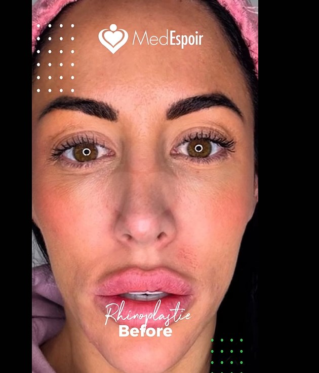 Photo avant rhinoplastie Marie Maxime

