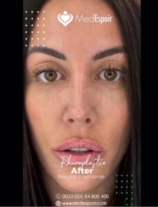 chirurgie nez barbie marie maxime tunisie