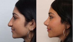 barbier nose avant apres 2025