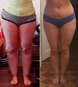 Résultat après liposuccion lipœdème jambes affinées