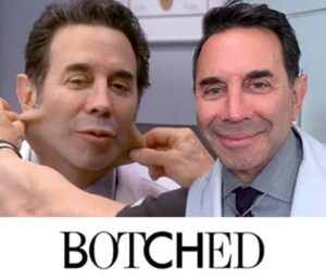 Paul nassif avant apres lifting visage post ozempic amaigrissement