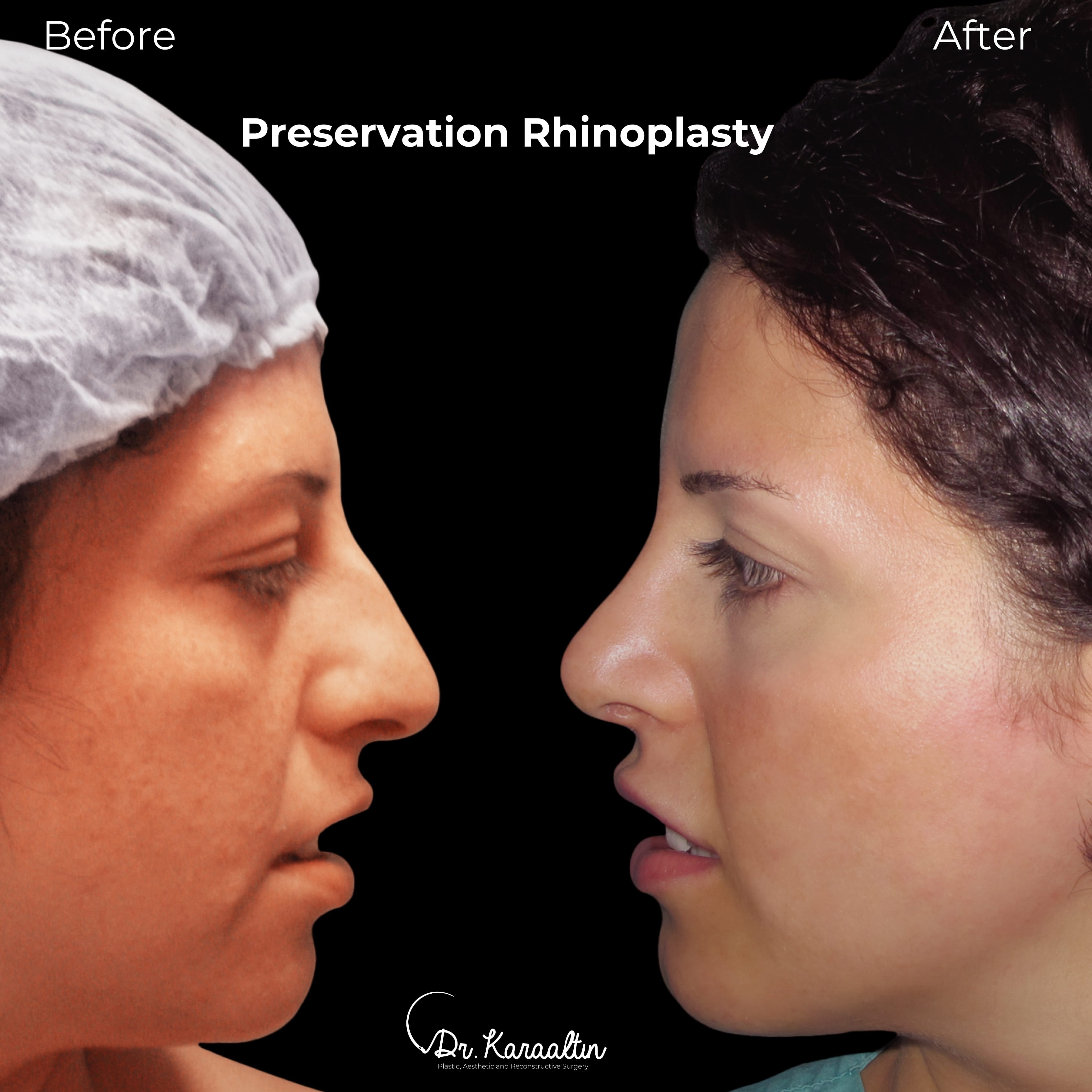 nasen op kosten vorher-nachher