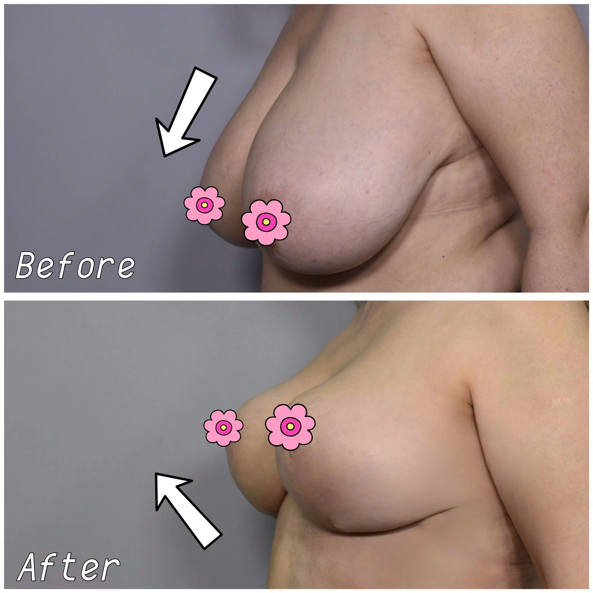 breast lift before and after turkey 