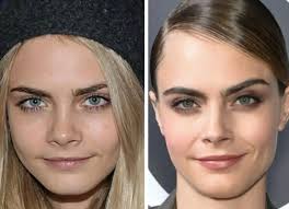 cara delevingne after feminine rhinoplasty