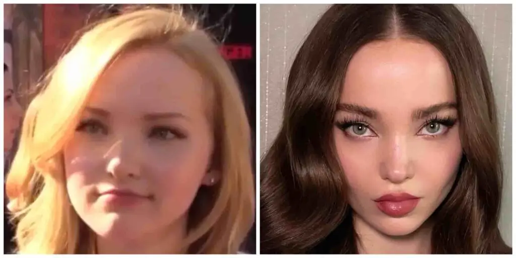 dove cameron doll-like nose rhinoplasty