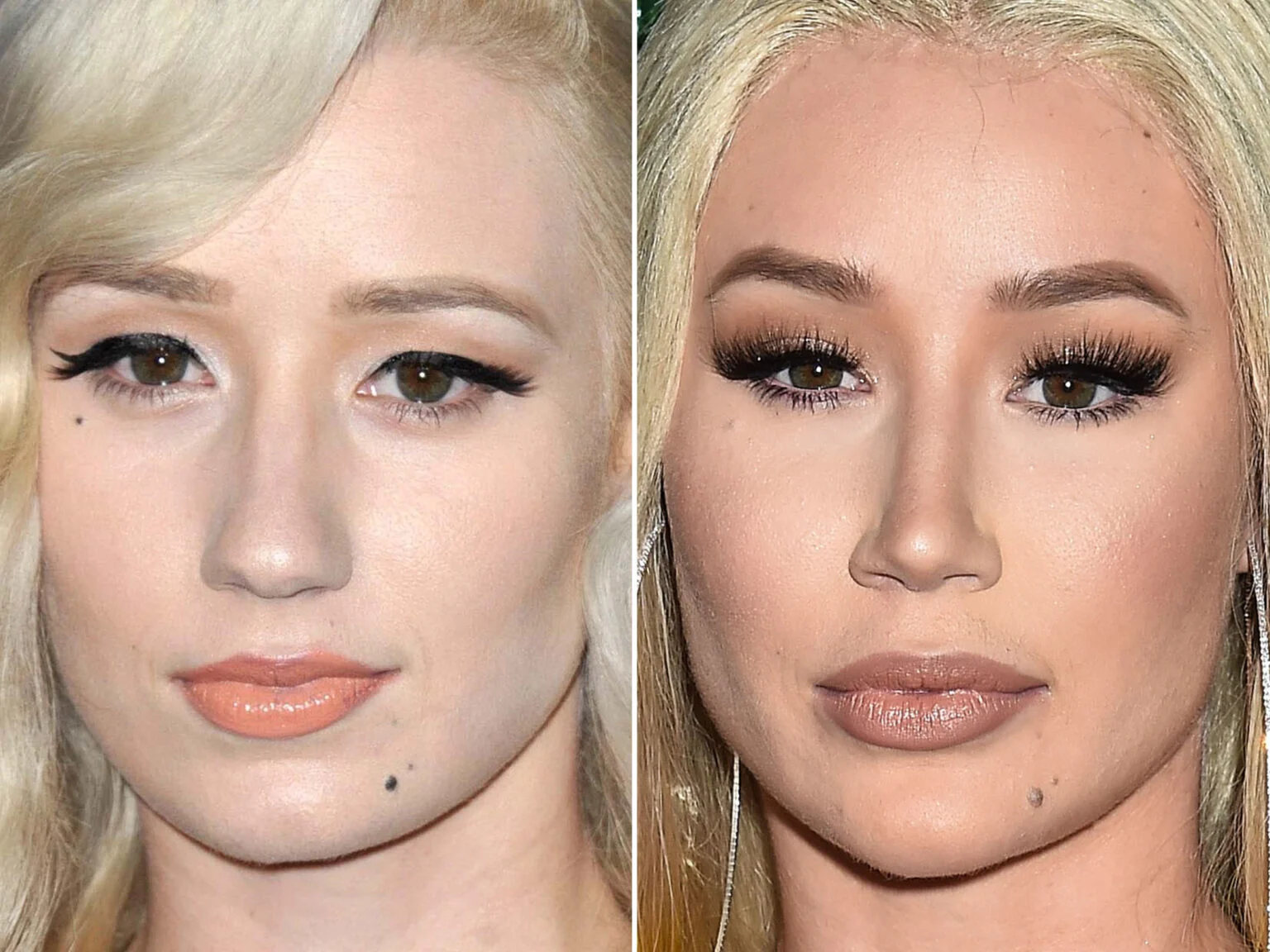 iggy azalea before and after nose job