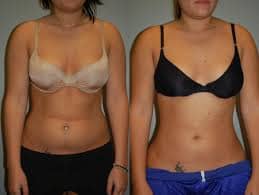 liposuction Turkey before and after