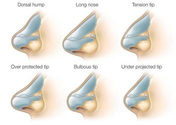 Types Of Noses To Achieve With Rhinoplasty in Turkey 