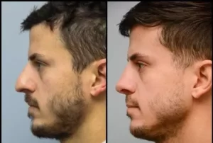 nose job rhinoplasty men qatar