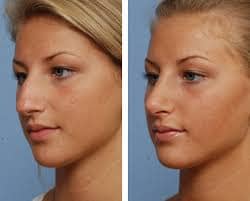 rhinoplasty turkey before and after